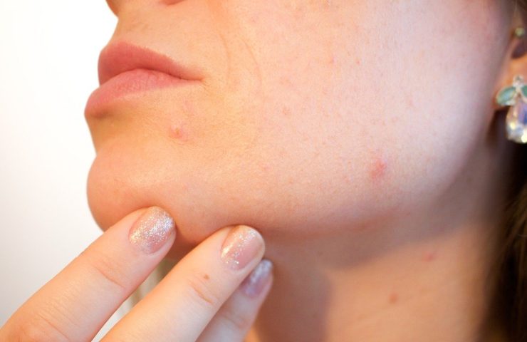 Acne su viso e collo come dirgli addio 