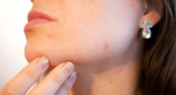 Acne addio, i segreti di bellezza da non farsi scappare assolutamente