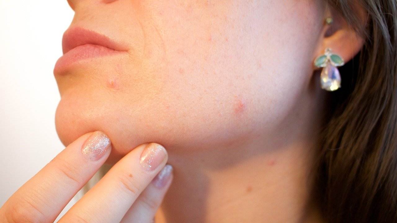 Acne sul viso come dirgli addio