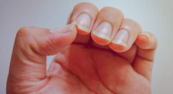 Righe sulle unghie: attenzione, potresti avere queste patologie