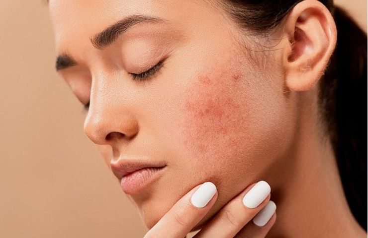 Acne addio soluzione 