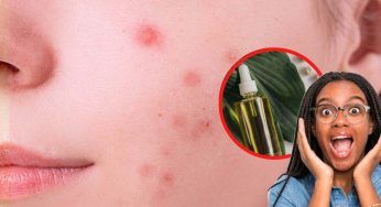 Soffri di acne? con poche gocce di questo prodotto eliminerai il problema una volta per tutte!