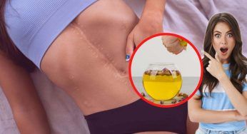 Cicatrici? Eliminale in meno di tre giorni utilizzando questo olio miracoloso!