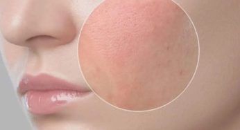 Rosacea: di cosa si tratta e come combatterla grazie a questo ingrediente