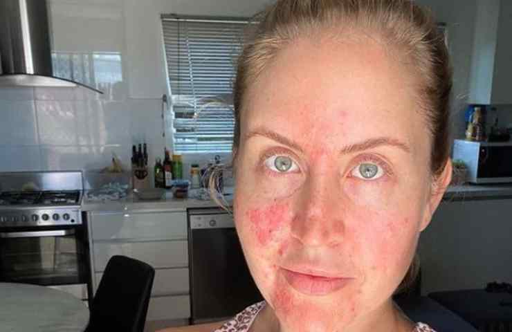 rosacea cos'è rimedi