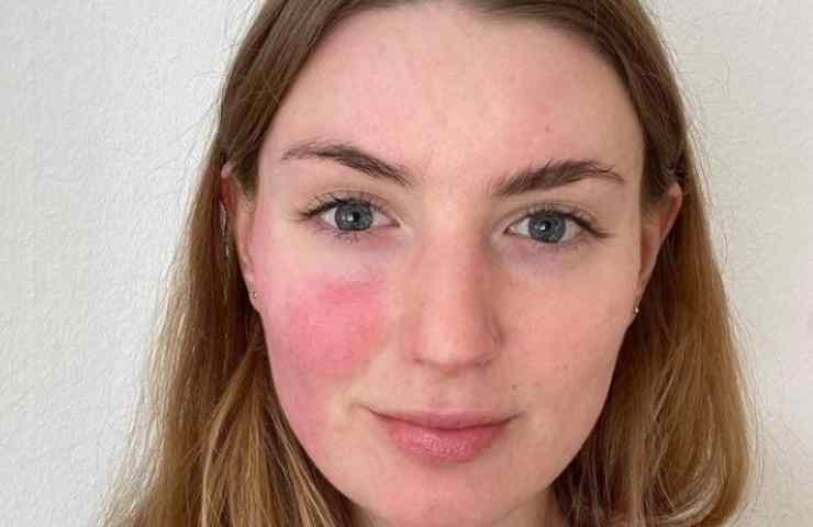 rosacea cos'è rimedi