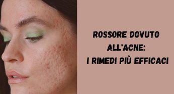 Rossore dovuto all’acne? Eliminalo con i rimedi naturali più efficaci di sempre