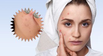 Punti neri e brufoli, non ti trattieni dallo schiacciarli? In realtà c’è un motivo psicologico dietro