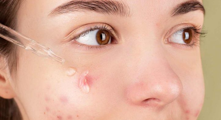 Skincare per pelli impure: la beauty routine per eliminare le imperfezioni