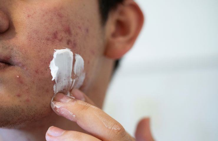 trattamento dell'acne con prodotti naturali