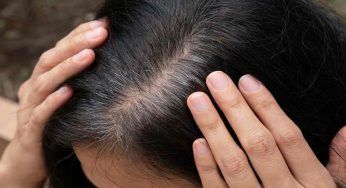 Conosci il “fenomeno Maria Antonietta”: riguarda i capelli e lo stress